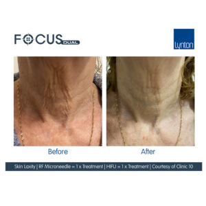 HIFU Before Afters Wirral Merseyside Cosmetic Perfection