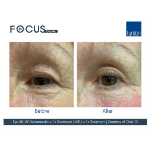 HIFU Before Afters Wirral Merseyside Cosmetic Perfection