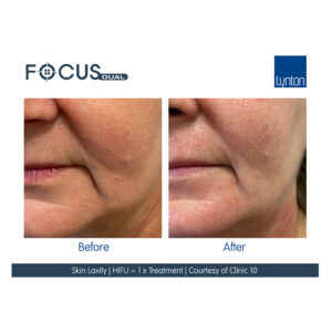 HIFU Before Afters Wirral Merseyside Cosmetic Perfection