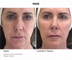 Before Afters Profhilo Skin Treatment Wirral Merseyside