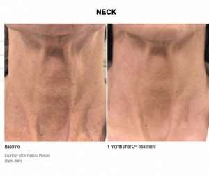 Before Afters Profhilo Skin Treatment Wirral Merseyside