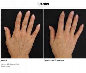 Before Afters Profhilo Skin Treatment Wirral Merseyside