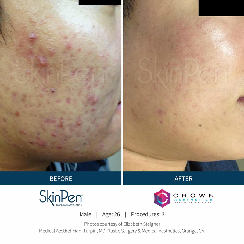 SkinPen Skin Treatment Wirral Merseyside Cosmetic Perfection