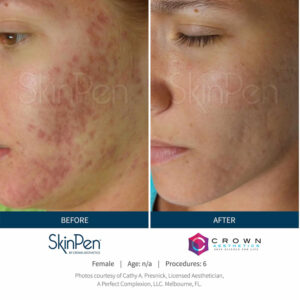 SkinPen Skin Treatment Wirral Merseyside Cosmetic Perfection