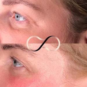 WOW Facial Treatment Wirral Merseyside Cosmetic Perfection