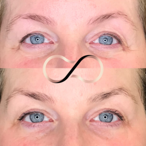 Cosmetic Perfection Wirral Botox Polynucleotides Treatments