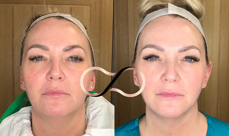 Cosmetic Perfection Wirral HIFU Treatment