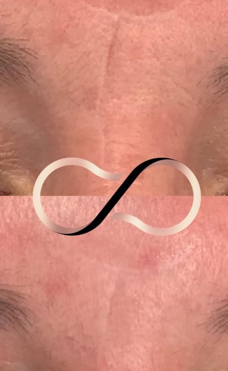 Cosmetic Perfection Wirral SkinPen Scar Reduction 1